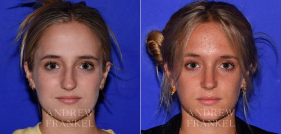 Rhinoplasty before and after photos in Beverly Hills, CA, Patient 17228