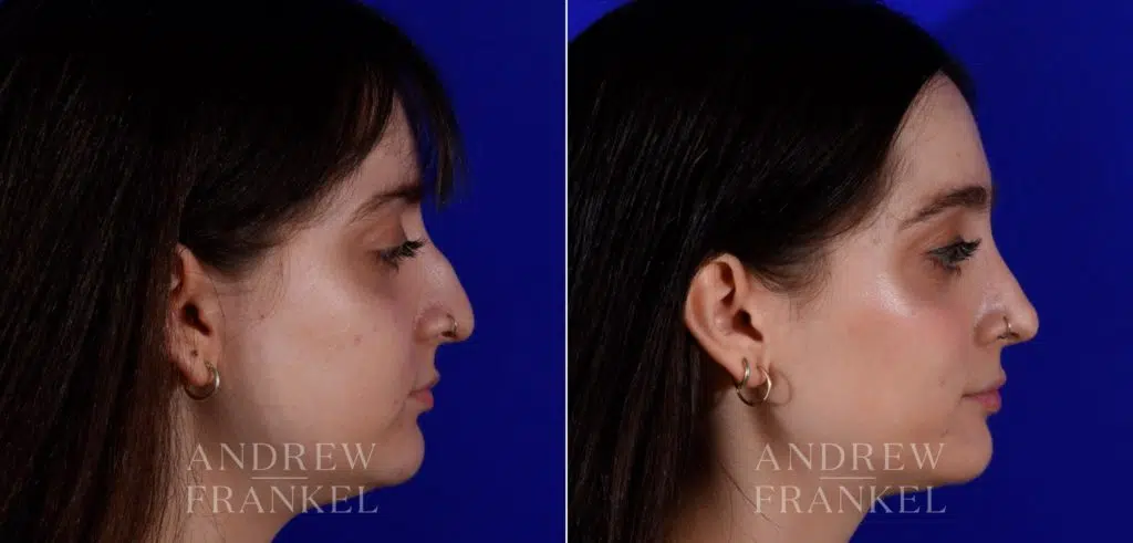 Rhinoplasty Beverly Hills | America's Best Rhinoplasty Surgeon
