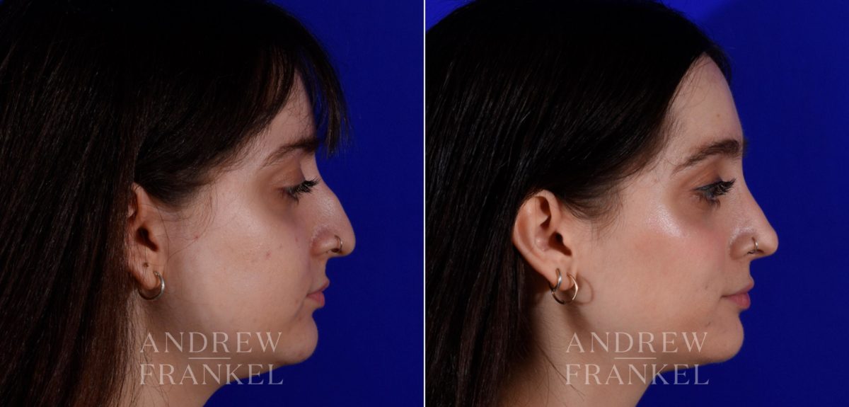 Rhinoplasty before and after photos in Beverly Hills, CA, Patient 17254