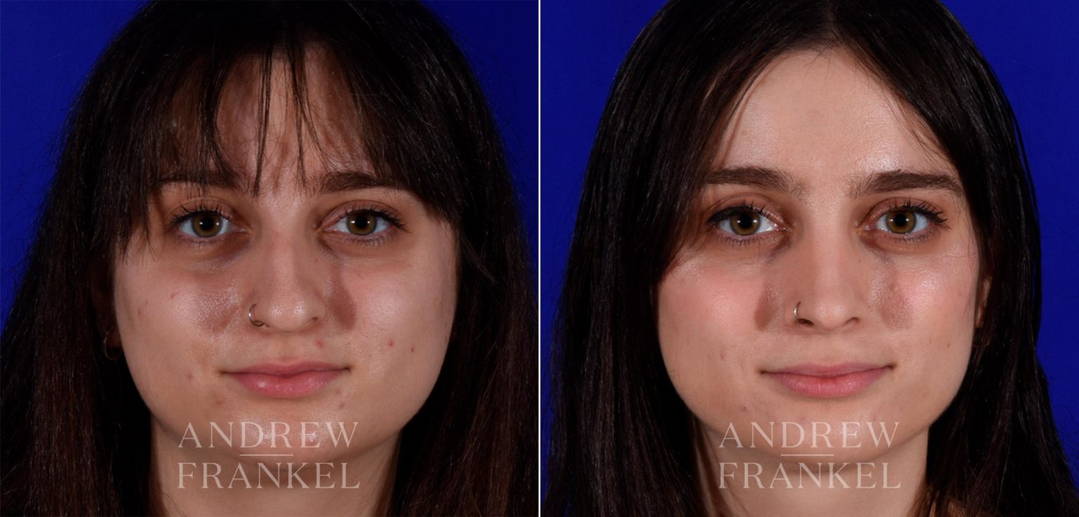 Rhinoplasty Beverly Hills | America's Best Rhinoplasty Surgeon