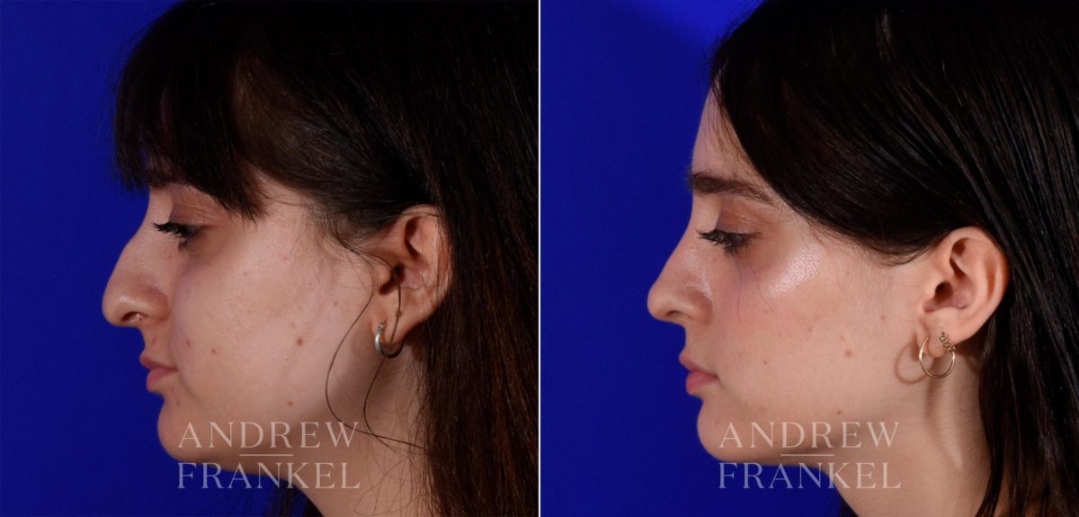 Rhinoplasty before and after photos in Beverly Hills, CA, Patient 17254