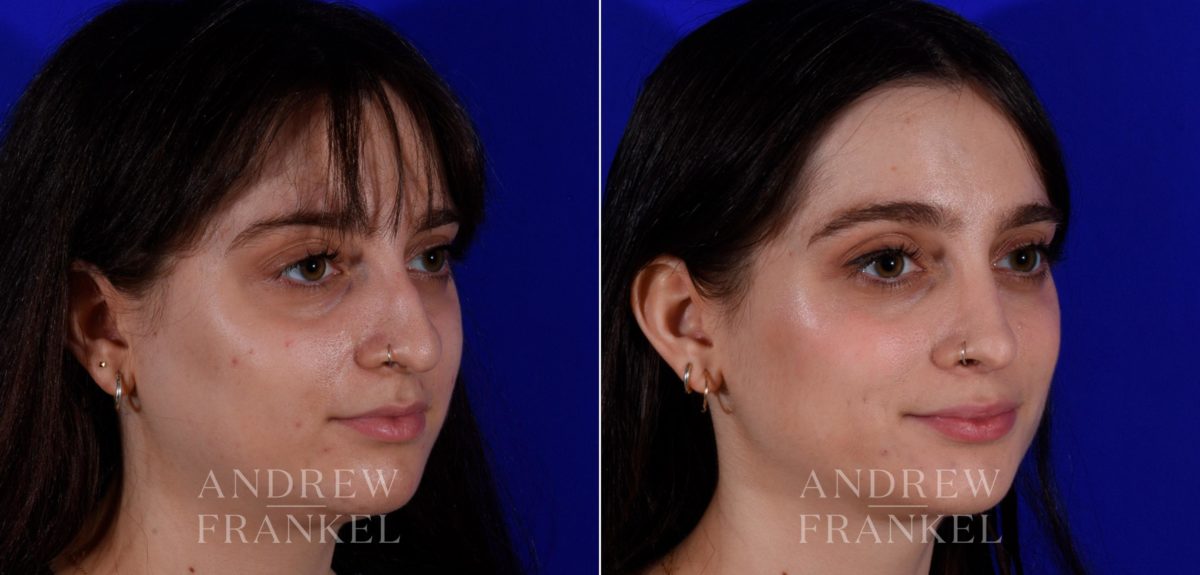 Rhinoplasty before and after photos in Beverly Hills, CA, Patient 17254