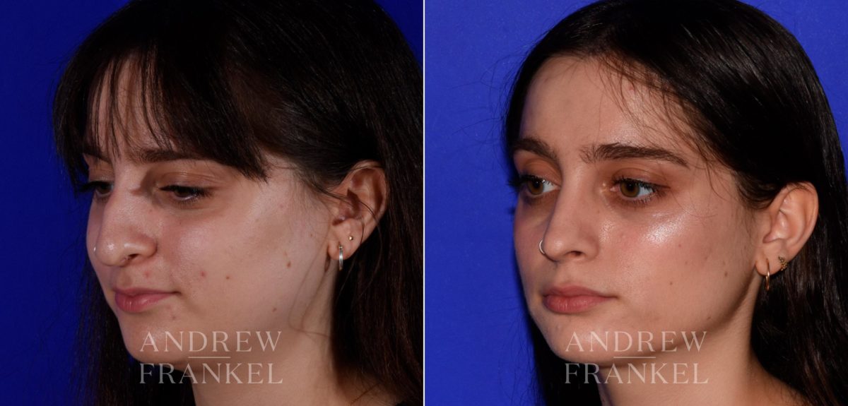 Rhinoplasty before and after photos in Beverly Hills, CA, Patient 17254