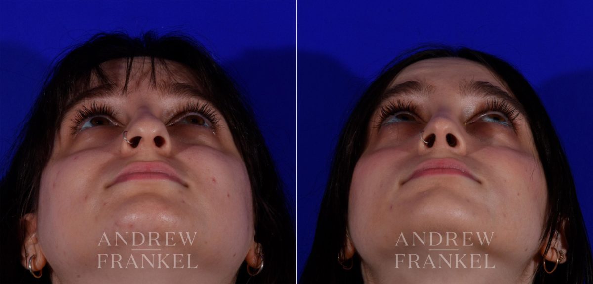 Rhinoplasty before and after photos in Beverly Hills, CA, Patient 17254