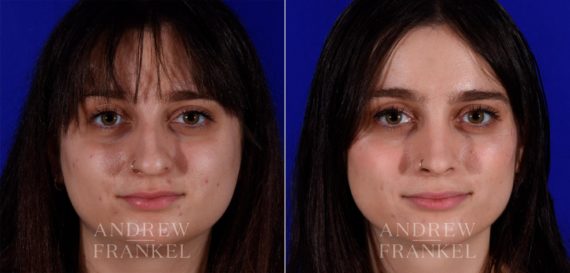 Rhinoplasty before and after photos in Beverly Hills, CA, Patient 17254