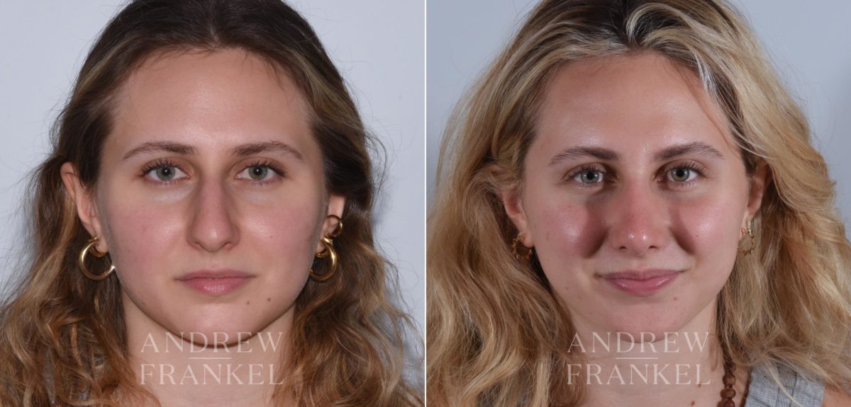 Rhinoplasty before and after photos in Beverly Hills, CA, Patient 17920