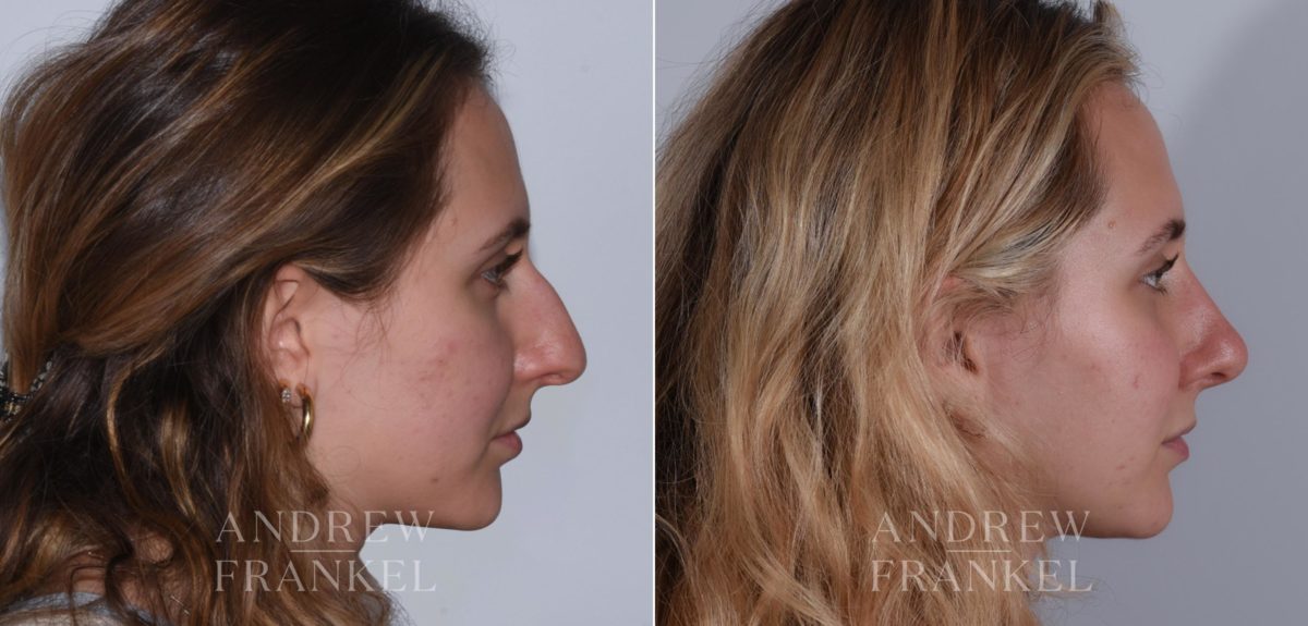 Rhinoplasty before and after photos in Beverly Hills, CA, Patient 17920