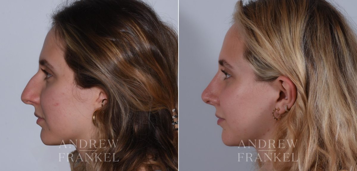 Rhinoplasty before and after photos in Beverly Hills, CA, Patient 17920