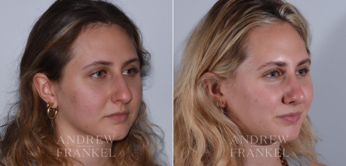 Rhinoplasty before and after photos in Beverly Hills, CA, Patient 17920