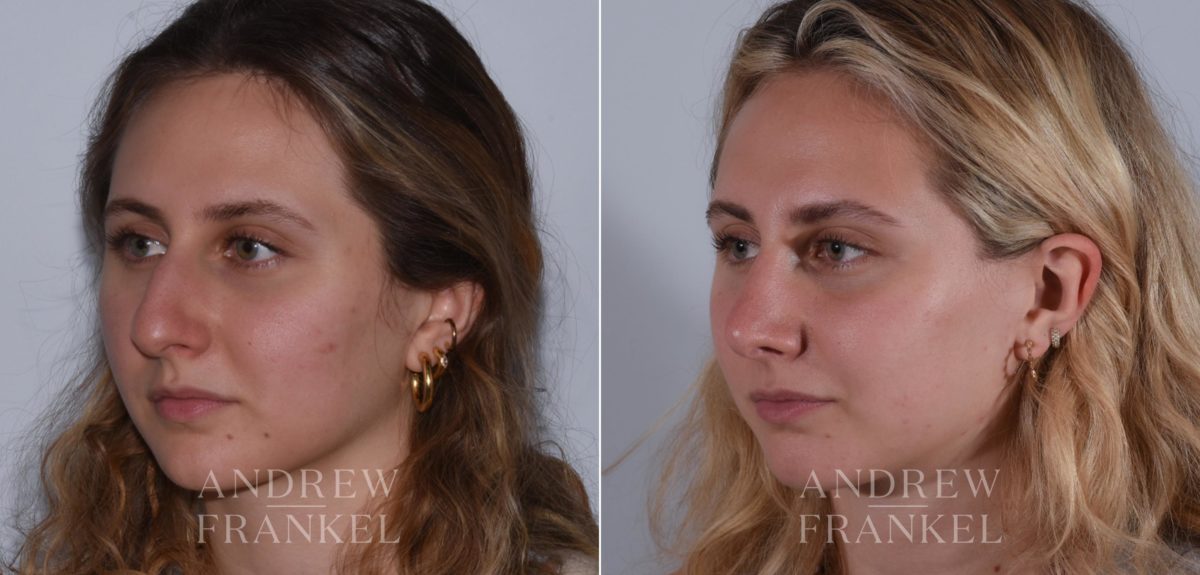 Rhinoplasty before and after photos in Beverly Hills, CA, Patient 17920