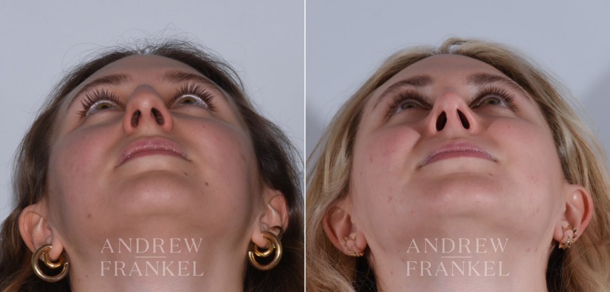 Rhinoplasty before and after photos in Beverly Hills, CA, Patient 17920
