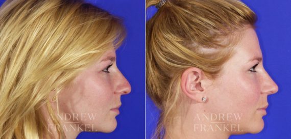 Rhinoplasty before and after photos in Beverly Hills, CA, Patient 6089