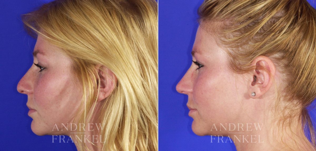 Rhinoplasty before and after photos in Beverly Hills, CA, Patient 6089