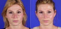 Rhinoplasty before and after photos in Beverly Hills, CA, Patient 6089