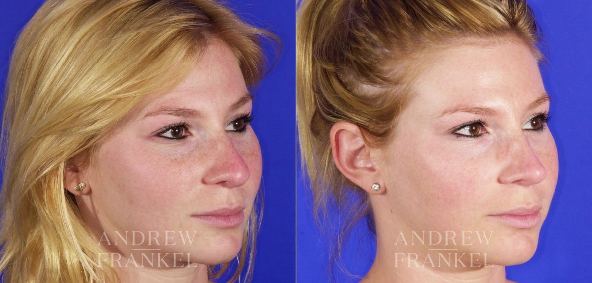 Rhinoplasty before and after photos in Beverly Hills, CA, Patient 6089