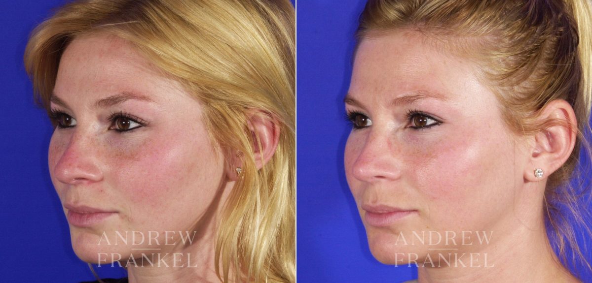 Rhinoplasty before and after photos in Beverly Hills, CA, Patient 6089