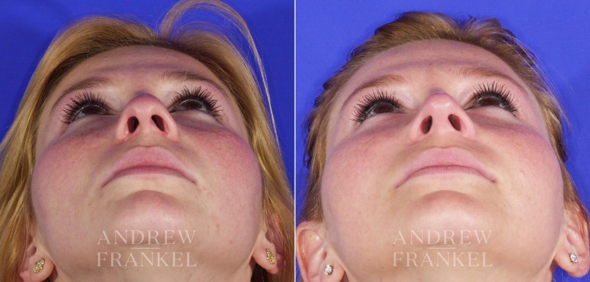Rhinoplasty before and after photos in Beverly Hills, CA, Patient 6089