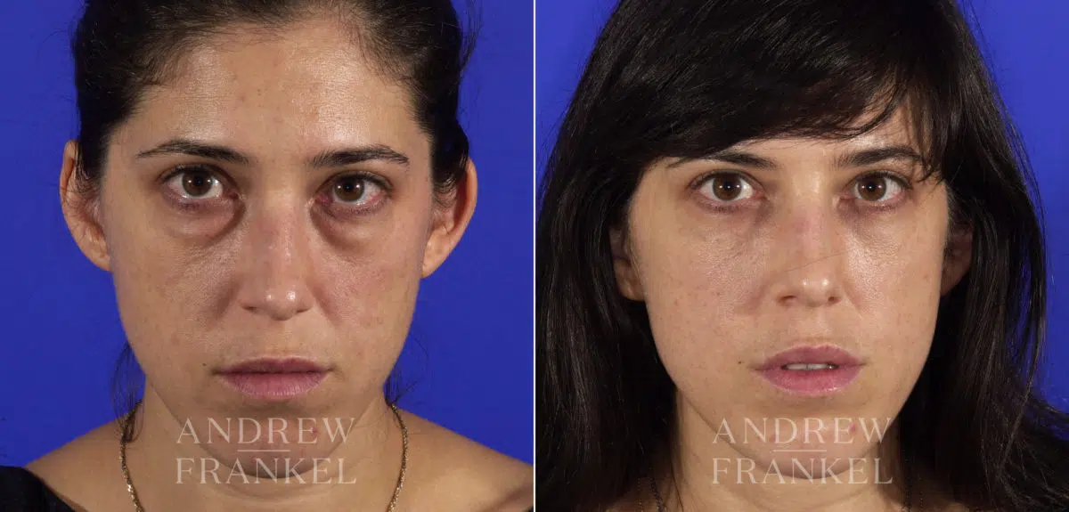 Blepharoplasty before and after photos in Beverly Hills, CA, Patient 3247