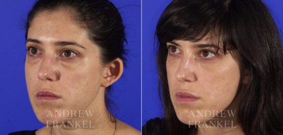 Blepharoplasty before and after photos in Beverly Hills, CA, Patient 3247