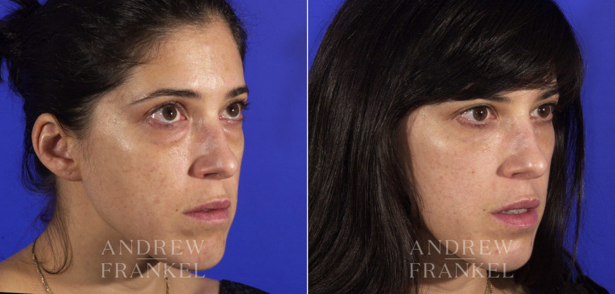 Blepharoplasty before and after photos in Beverly Hills, CA, Patient 3247