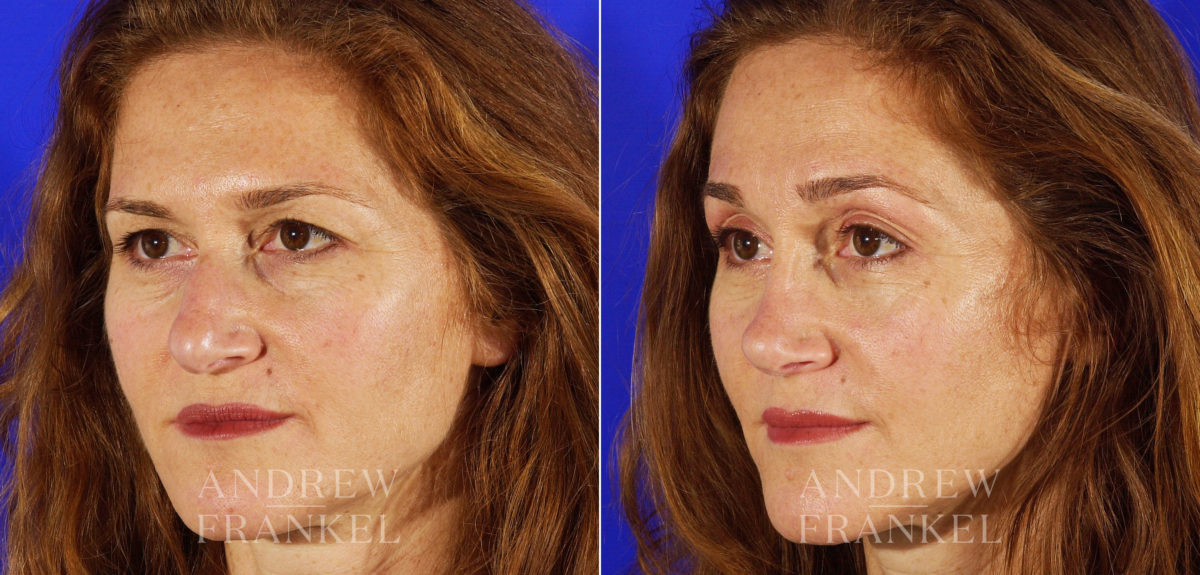 Blepharoplasty before and after photos in Beverly Hills, CA, Patient 3260