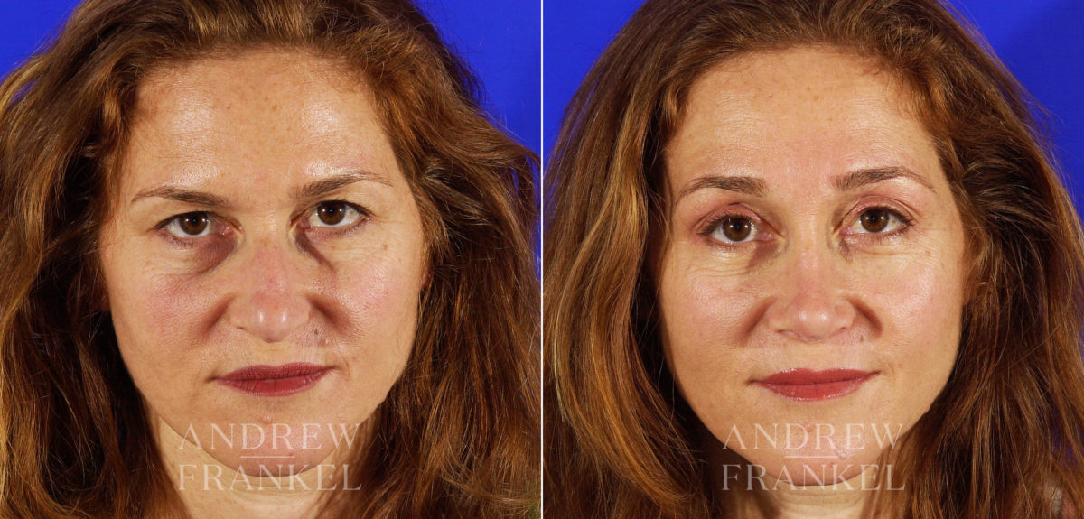 Blepharoplasty before and after photos in Beverly Hills, CA, Patient 3260