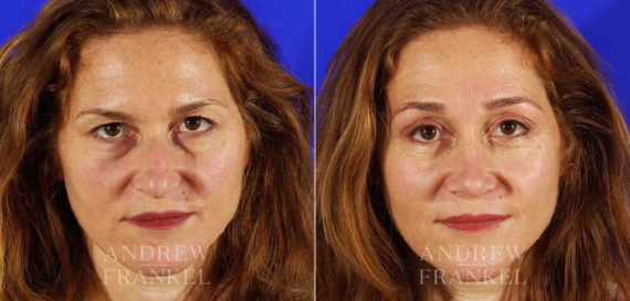 Blepharoplasty before and after photos in Beverly Hills, CA, Patient 3260