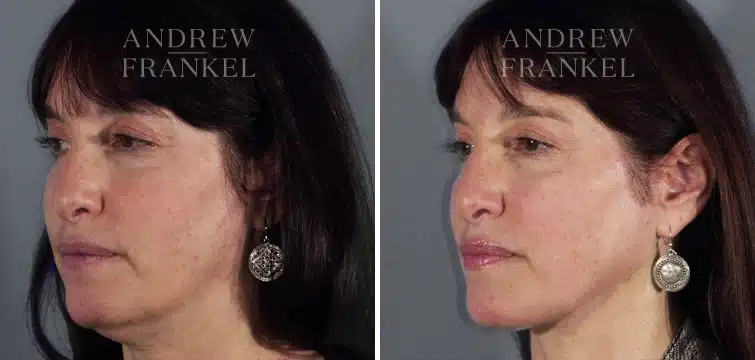 Neck Lift galleries