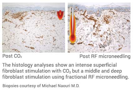 Hystology analysis post CO2 and RF Microneedling