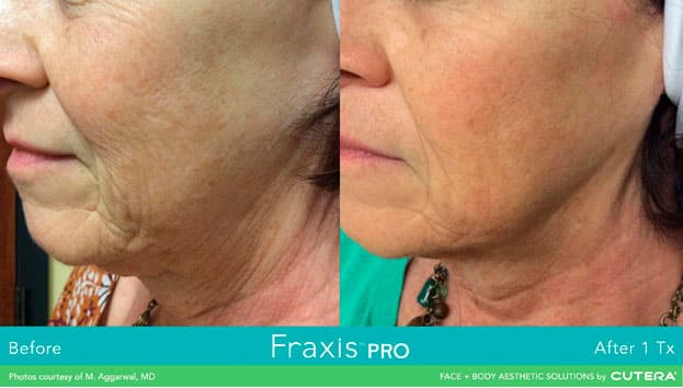 Before and after comparison of a Fraxis PRO patient with wrinkles