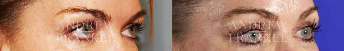 Brow Lift before and after photos in Beverly Hills, CA, Patient 3477