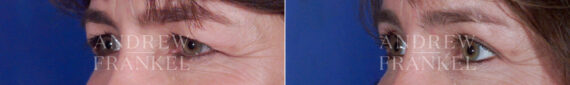 Brow Lift before and after photos in Beverly Hills, CA, Patient 3486