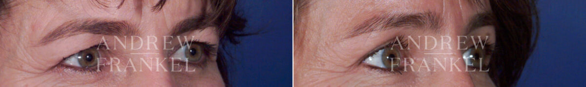Brow Lift before and after photos in Beverly Hills, CA, Patient 3486