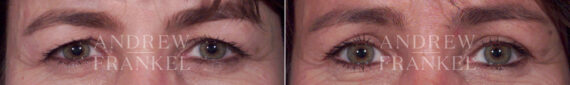 Brow Lift before and after photos in Beverly Hills, CA, Patient 3486