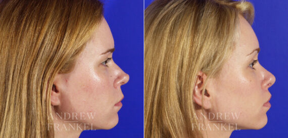 Revision Rhinoplasty before and after photos in Beverly Hills, CA, Patient 3937