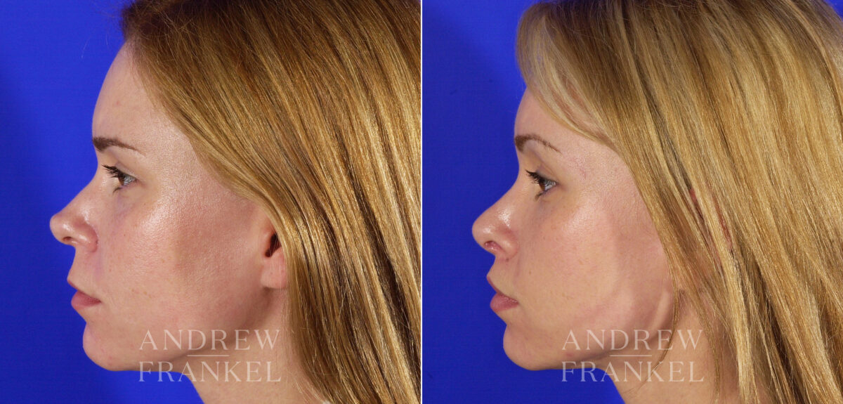 Revision Rhinoplasty before and after photos in Beverly Hills, CA, Patient 3937