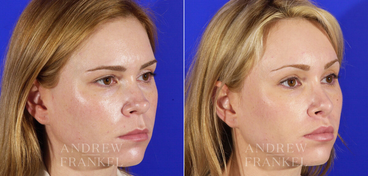 Revision Rhinoplasty before and after photos in Beverly Hills, CA, Patient 3937