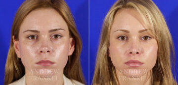 Revision Rhinoplasty before and after photos in Beverly Hills, CA, Patient 3937