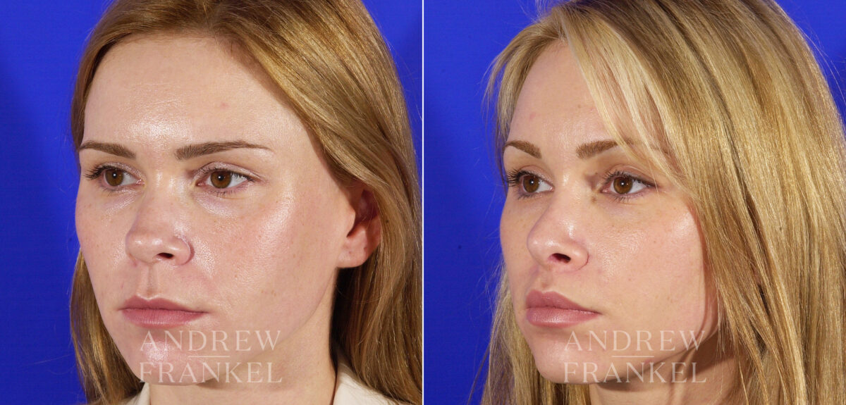 Revision Rhinoplasty before and after photos in Beverly Hills, CA, Patient 3937