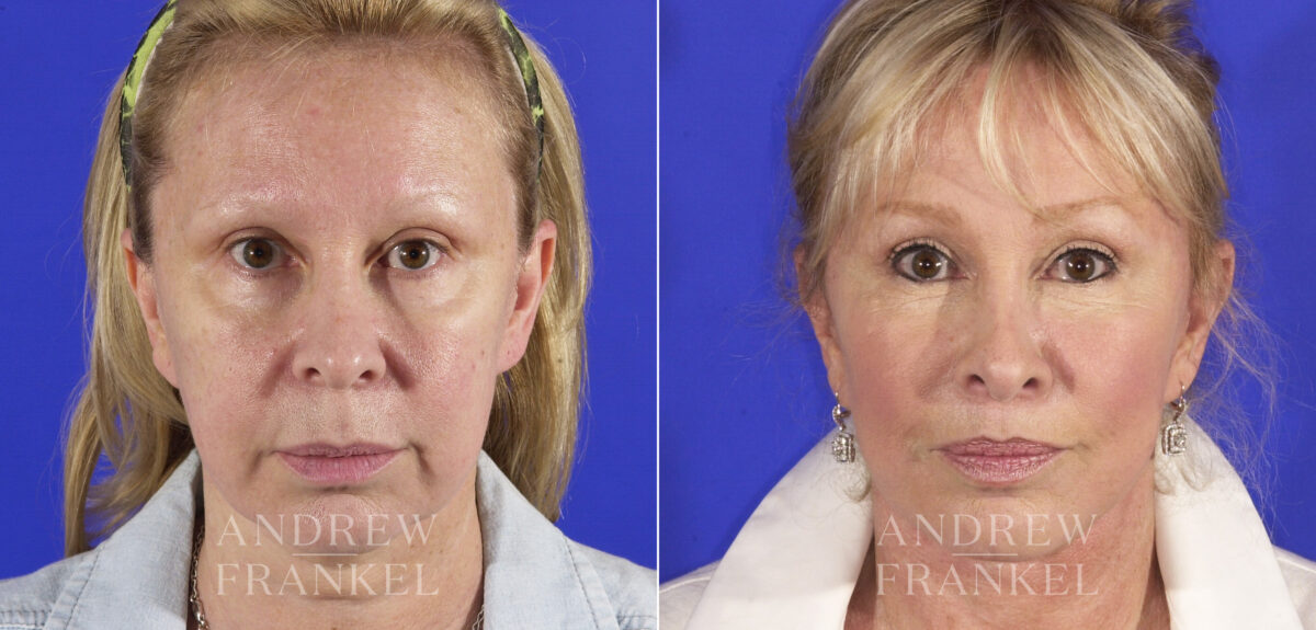 Midface Lift before and after photos in Beverly Hills, CA, Patient 4409