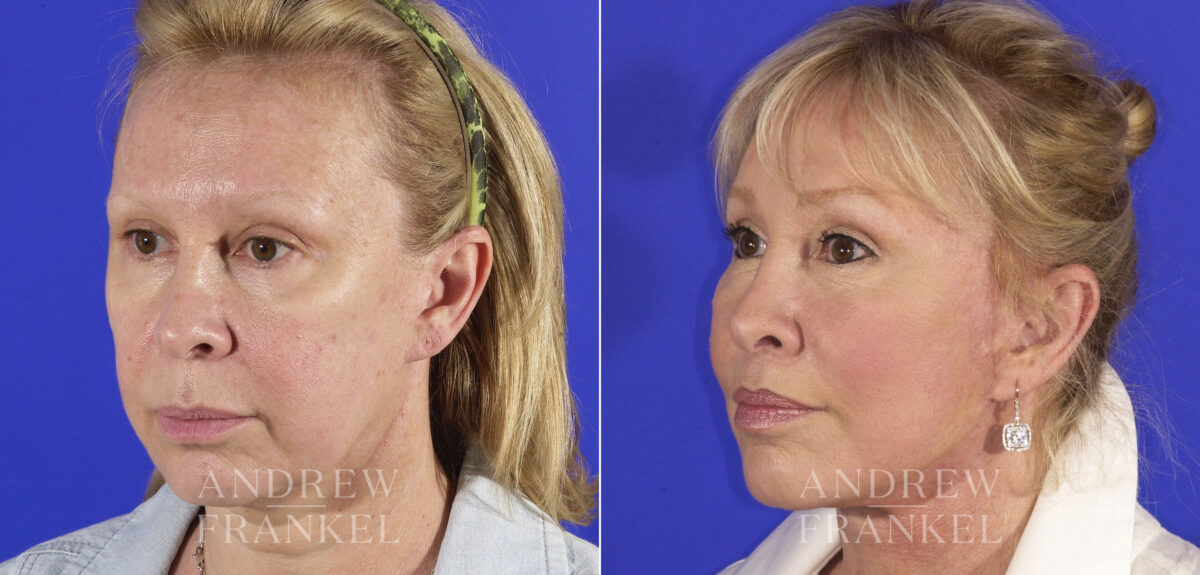 Midface Lift before and after photos in Beverly Hills, CA, Patient 4409