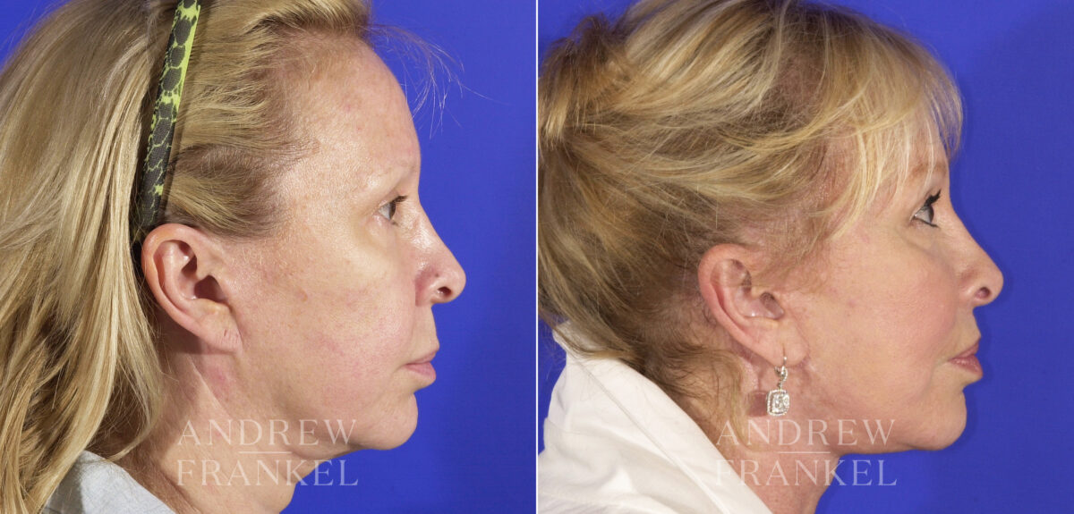 Midface Lift before and after photos in Beverly Hills, CA, Patient 4409