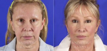 Midface Lift before and after photos in Beverly Hills, CA, Patient 4409