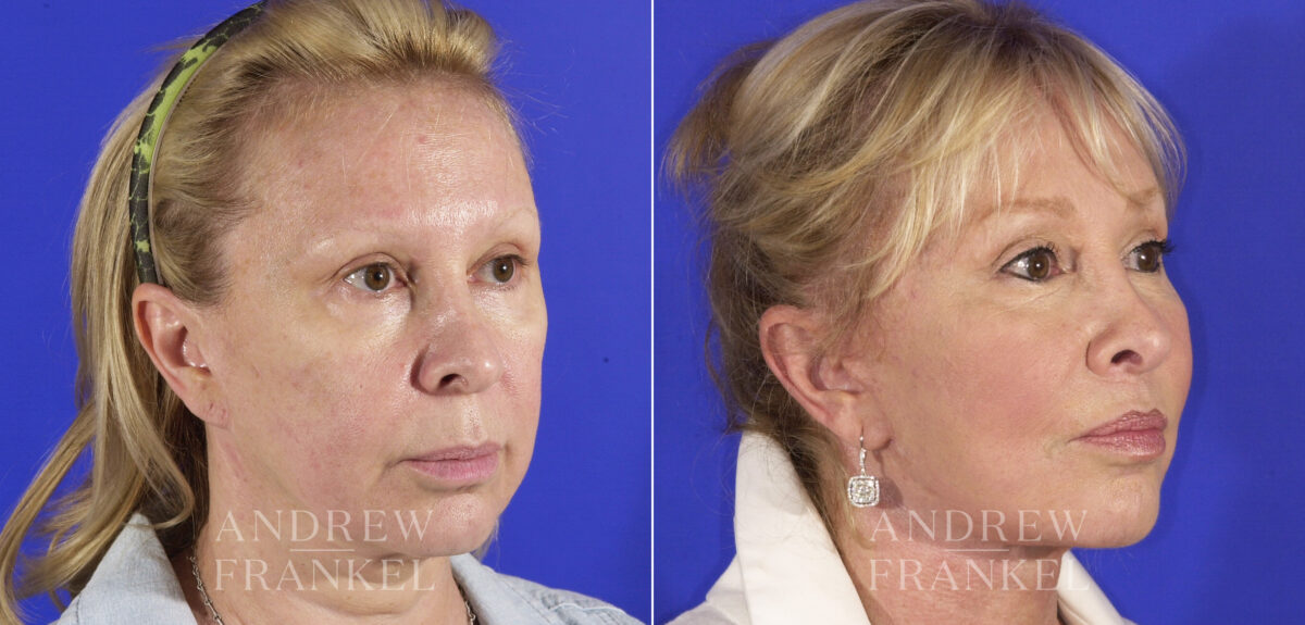 Midface Lift before and after photos in Beverly Hills, CA, Patient 4409