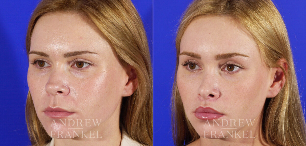 Lip Lift before and after photos in Beverly Hills, CA, Patient 4431