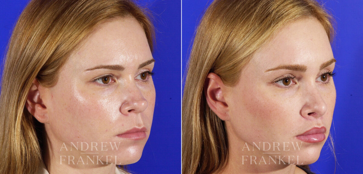 Lip Lift before and after photos in Beverly Hills, CA, Patient 4431