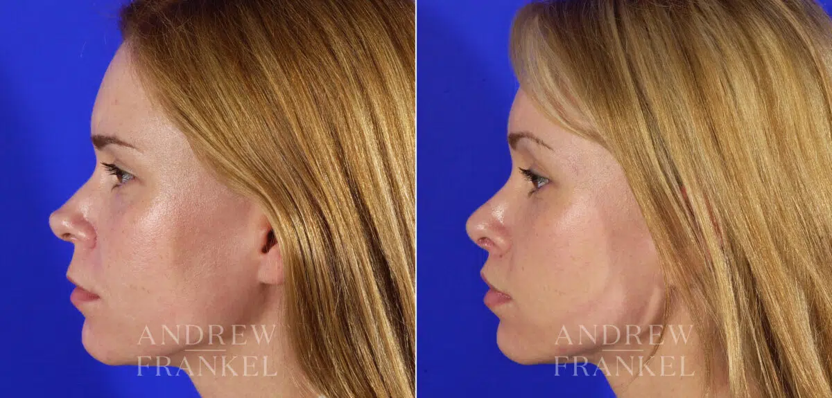 Lip Lift before and after photos in Beverly Hills, CA, Patient 4431