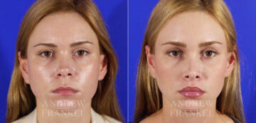 Lip Lift before and after photos in Beverly Hills, CA, Patient 4431