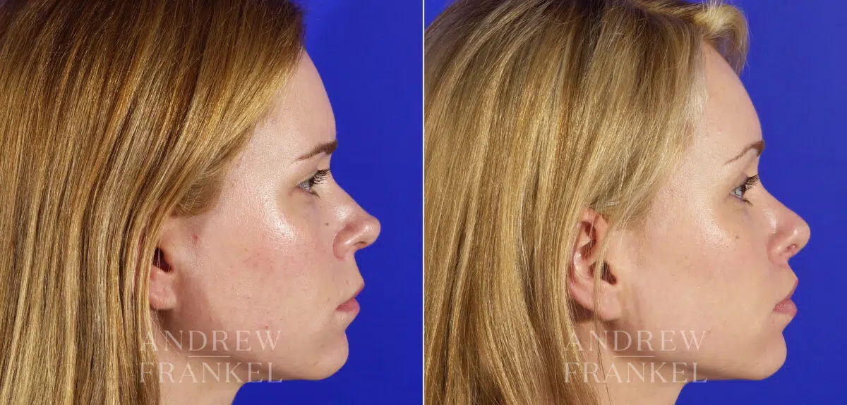 Lip Lift before and after photos in Beverly Hills, CA, Patient 4431