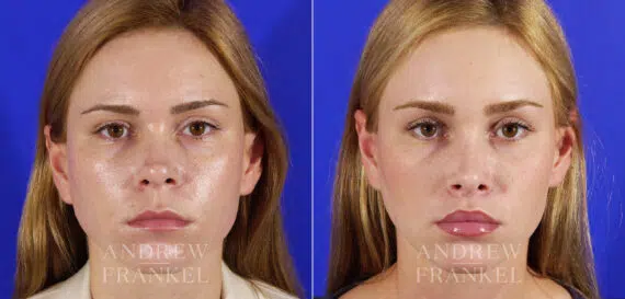 Lip Lift before and after photos in Beverly Hills, CA, Patient 4431